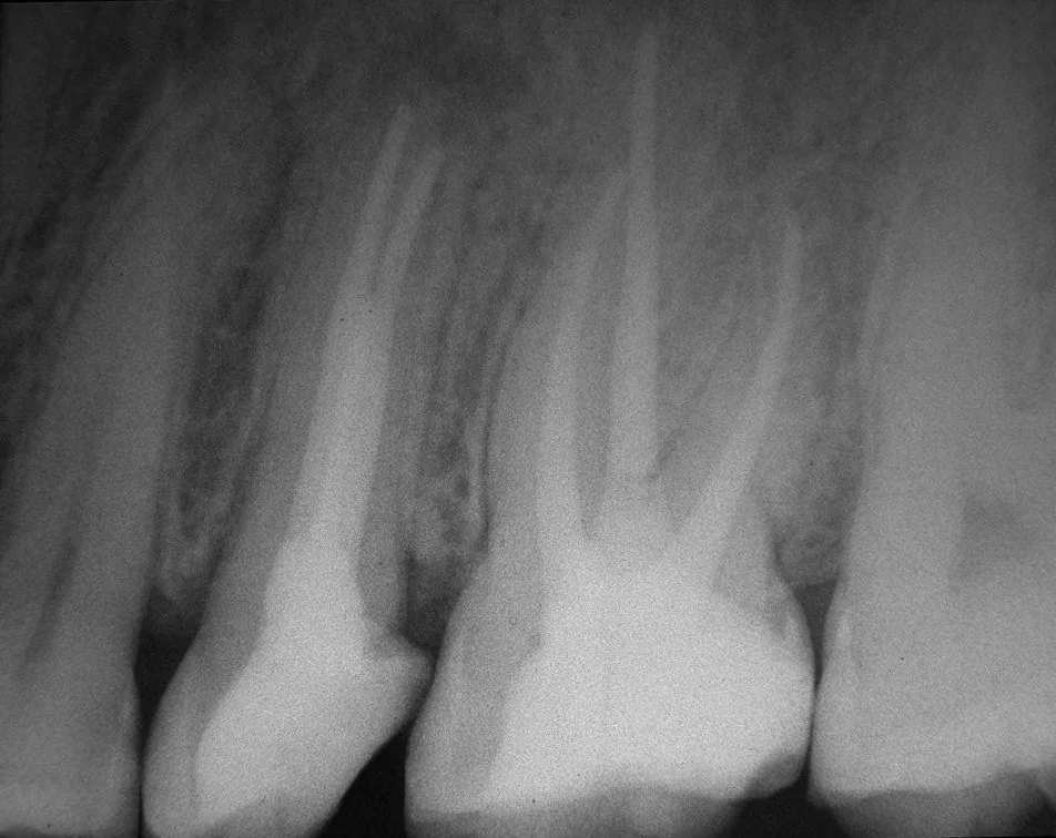 Radiografía de dientes superiores con los conductos ya rellenos: las líneas blancas son la gutapercha.