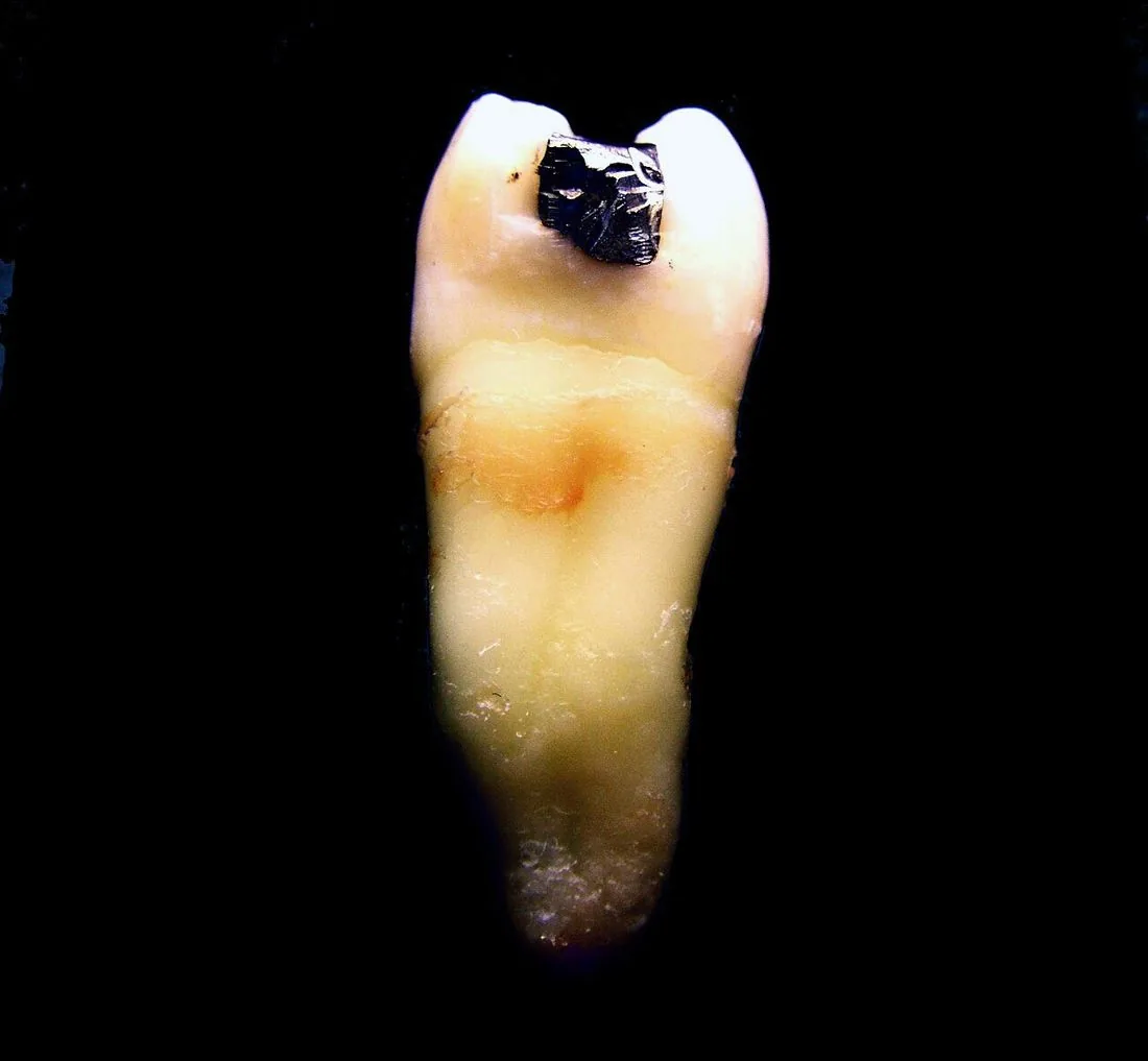 Ejemplo real: premolar extraído con una restauración de amalgama clase II de Black (en una cara proximal).
