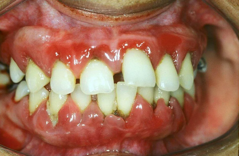 Periodontitis avanzada: encía inflamada, dientes que se separan y se mueven por la pérdida de hueso.